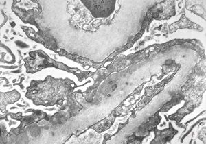 M,39y. | membranous glomerulonephritis